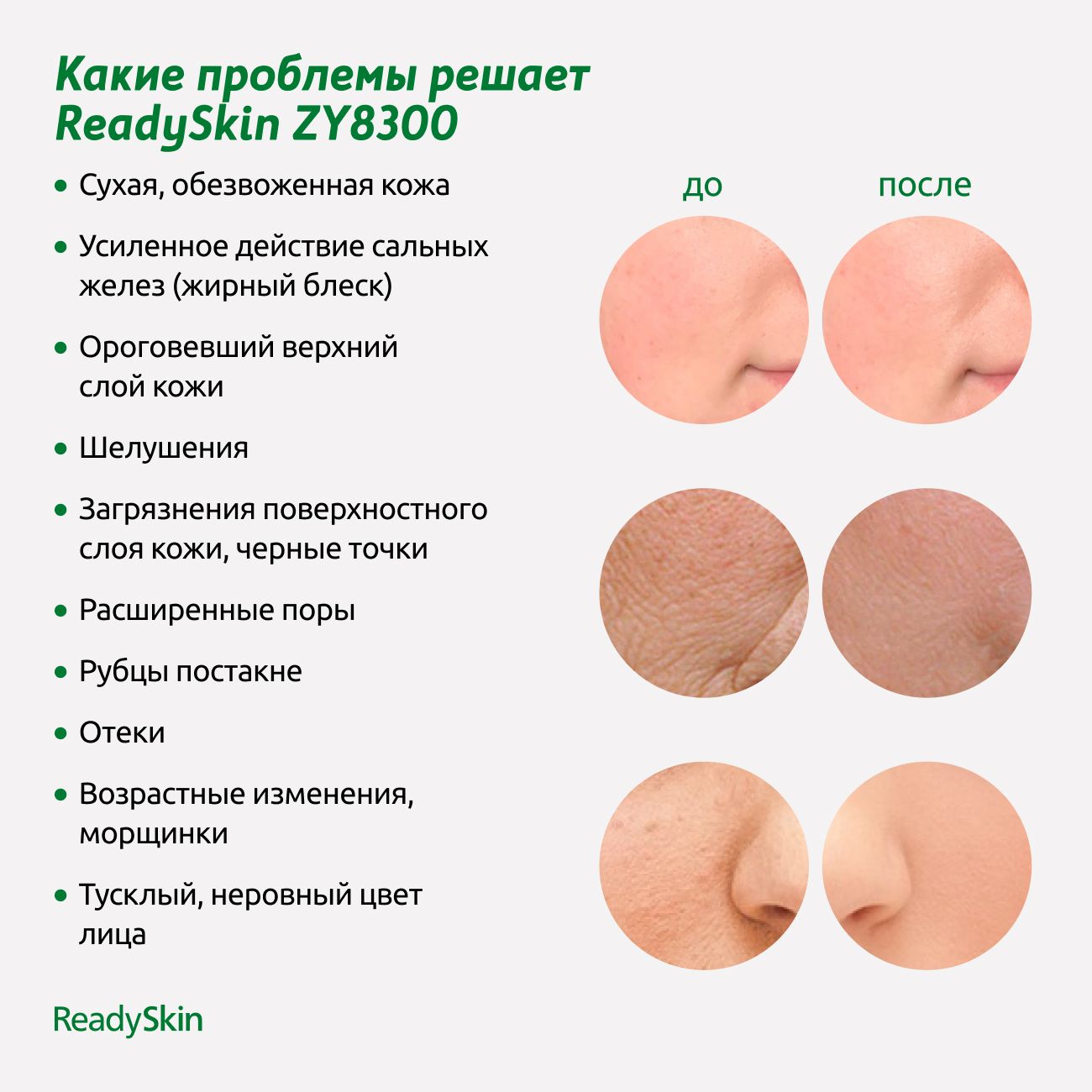 Аппарат для ультразвуковой чистки лица ReadySkin  ZY8300,микротоки,ионофорез,термомассаж,лифтинг